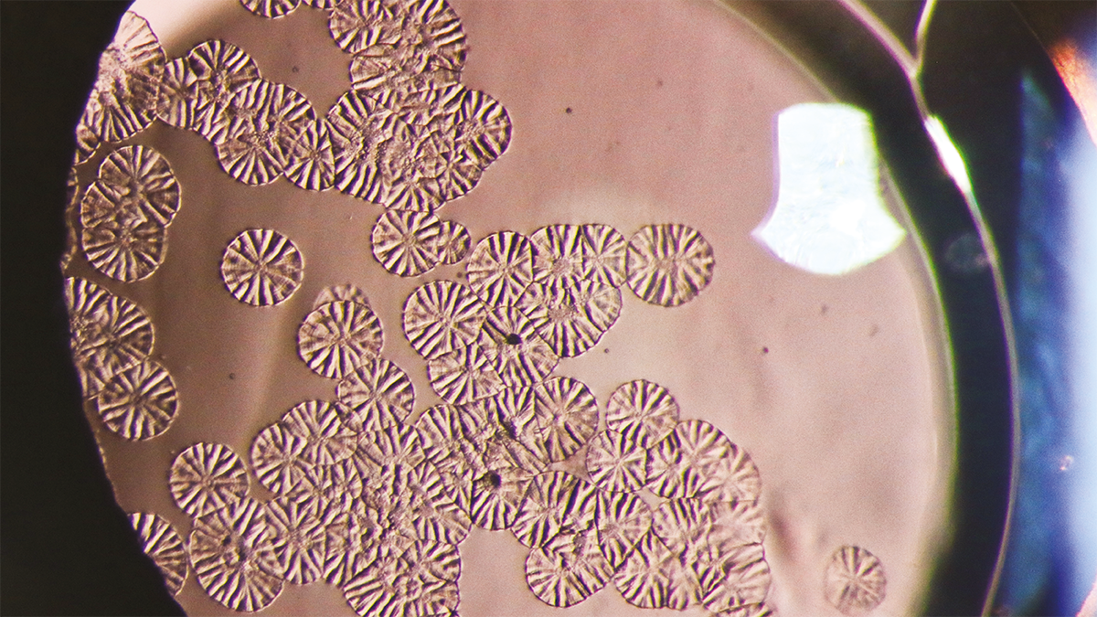 Image caption: Lotus surface opacity of intraocular lens by Yang Zhang, Beijing Tongren Hospital, China