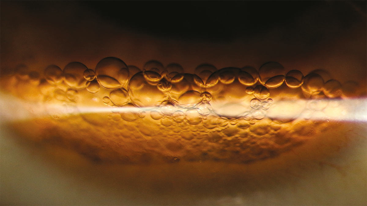 Image caption: PFO bubbles by Timothy Costello, Kellogg Eye Center, USA