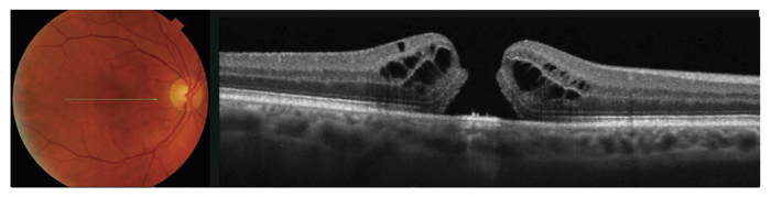 Figure 1: Color fundus image and OCT scan from a 71-year-old male with a full thickness macular hole.
