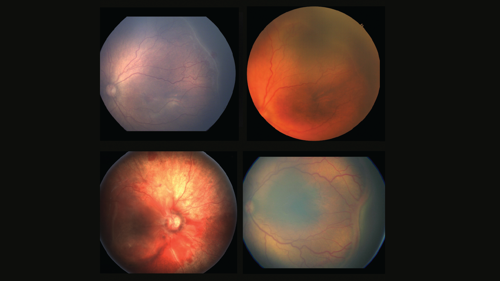 0525-501-F-Retina-Retinal-Exams-in-Children-InArticle1.png