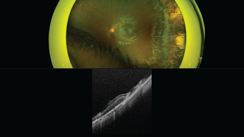 0525-501-F-Retina-Retinal-Exams-in-Children-InArticle2.png