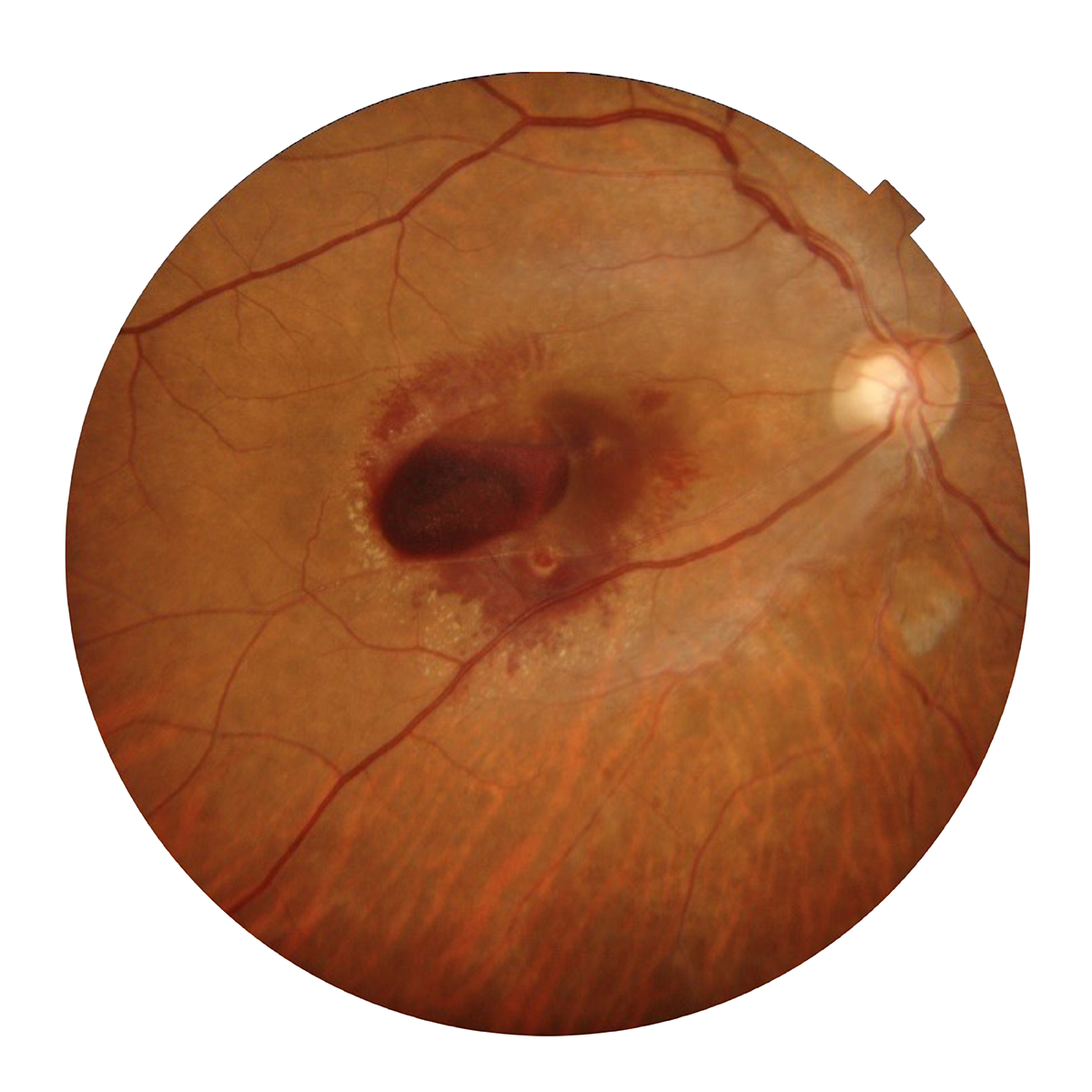 Retinal Hemorrhage*