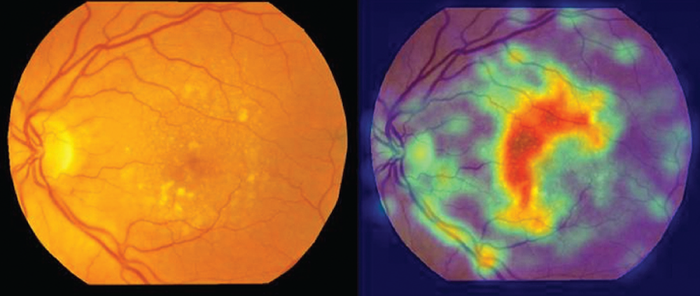 Figure 3: A deep learning system creates a heat map quantifying drusen in a patient with AMD.
