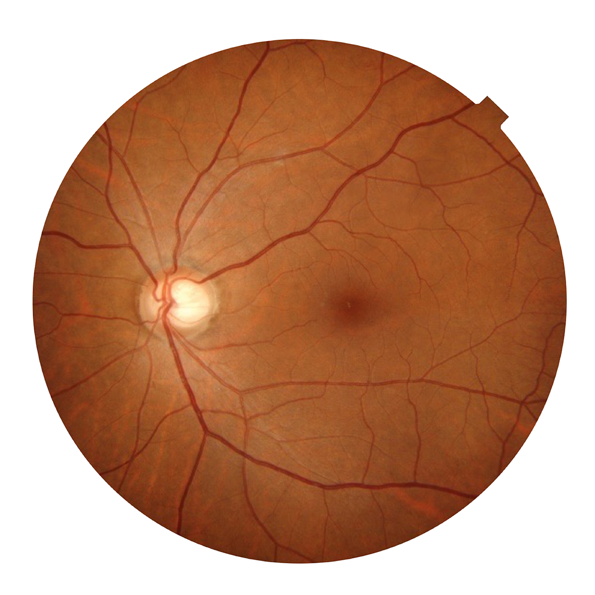 Glaucoma*
