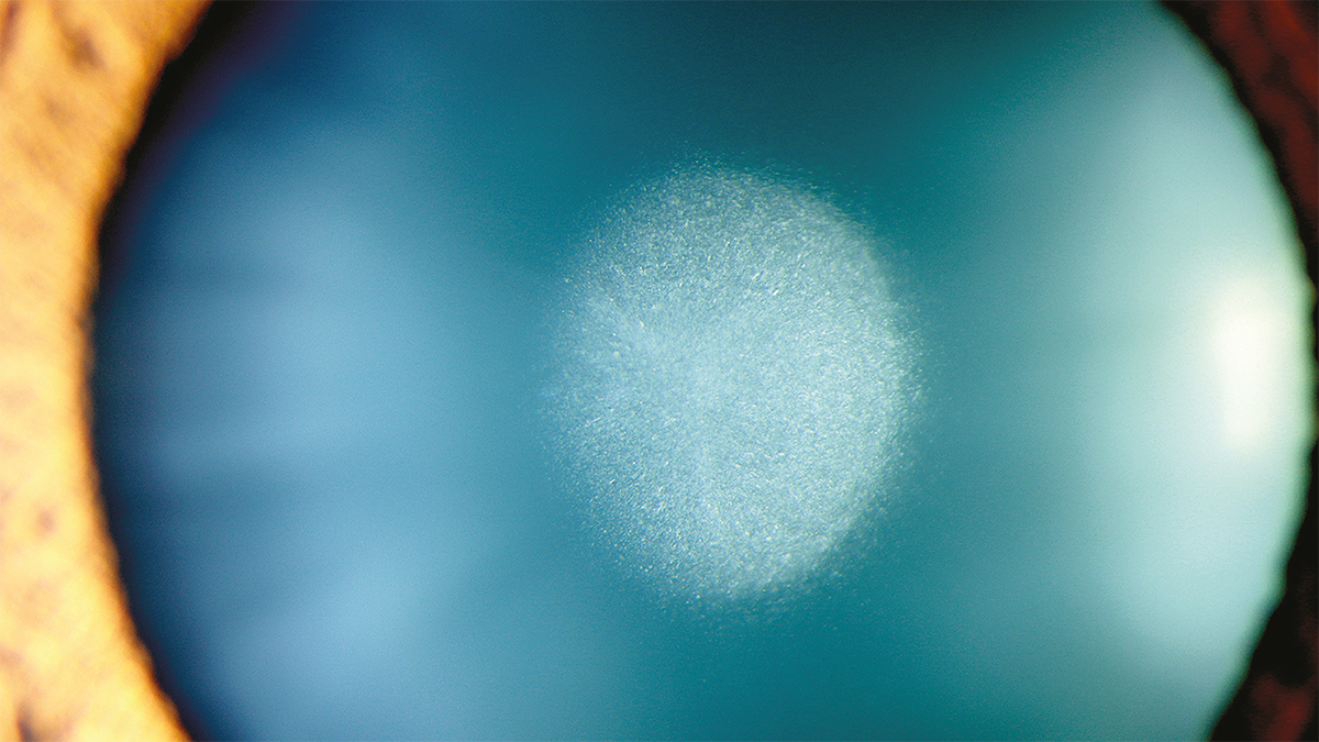 Image caption: Congenital cataract by Carmen Rodrigues, Lucerne Cantonal Hospital, Switzerland