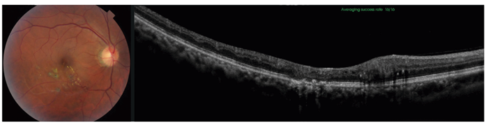 Figure 2: Color fundus image and OCT scan from an 85-year-old male with retinal vein occlusion.]