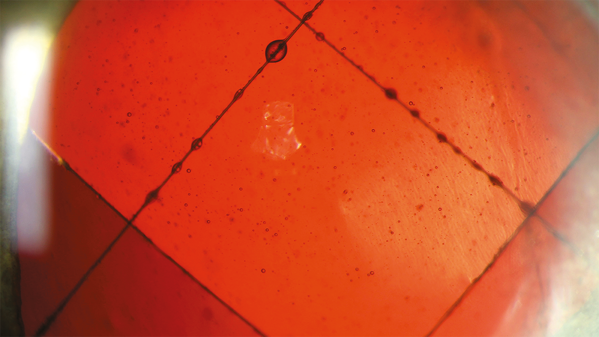 Image caption: Prolene mattress sutures, Re-ppV with silicone oil for recurrent retinal detachment following contusion of the eyeball by Pia Emilia Lohri, Lucerne Cantonal Hospital, Switzerland