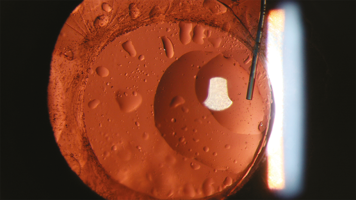 Image caption: Silicone oil adhered with the posterior capsule, behind the IOL by Samar Basak, DISHA Eye Hospitals, India
