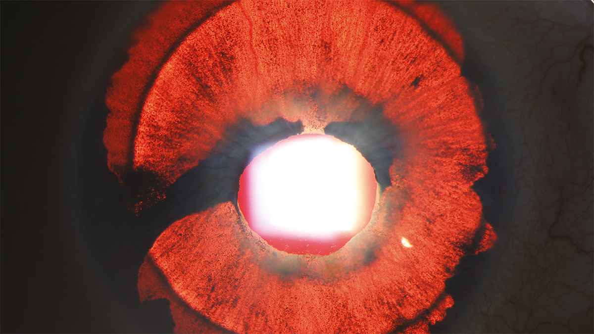 Image caption: Iris atrophy by Katie Lachut-Yevich, VCU Health System, USA