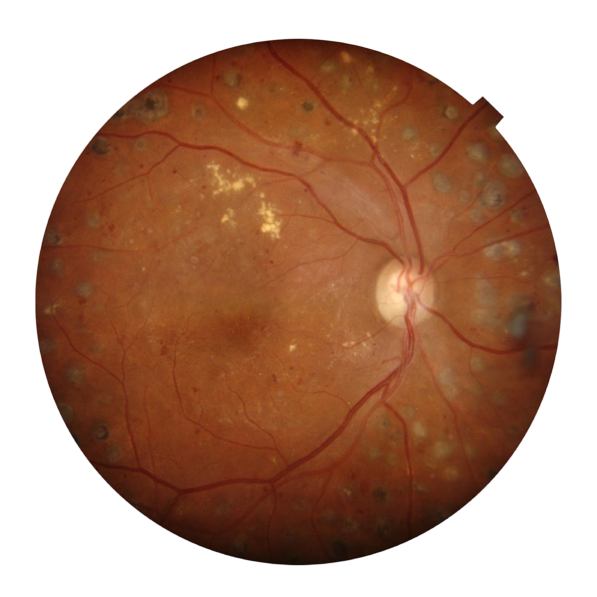 Diabetic Retinopathy*